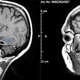 Imagen para el artículo titulado El hombre que terminó con pus en el tejido cerebral es el mejor ejemplo para dejar de meterte bastoncillos en el oído